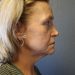 Facelift Patient 15 Before - 3 Thumbnail