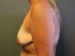 Breast Lift & Augmentation Patient 8 Before - 3 Thumbnail