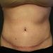 Tummy Tuck Patient 20 After Thumbnail