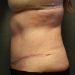 Tummy Tuck Patient 20 After - 2 Thumbnail