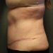 Tummy Tuck Patient 20 After - 2 Thumbnail
