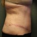 Tummy Tuck Patient 20 After - 4 Thumbnail