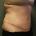 Tummy Tuck Patient 20 After - 5 Thumbnail