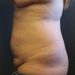 Tummy Tuck Patient 20 Before - 2 Thumbnail