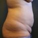Tummy Tuck Patient 20 Before - 4 Thumbnail