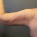 Arm Lift Patient 12 After - 4 Thumbnail