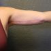 Arm Lift Patient 12 After Thumbnail