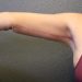 Arm Lift Patient 12 After - 3 Thumbnail