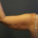 Arm Lift Patient 12 Before - 4 Thumbnail