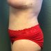 Tummy Tuck Patient 21 After - 2 Thumbnail