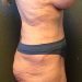 Tummy Tuck Patient 22 After - 5 Thumbnail