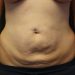 Tummy Tuck Patient 23 Before Thumbnail