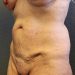 Tummy Tuck Patient 22 Before - 2 Thumbnail