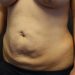Tummy Tuck Patient 23 Before - 3 Thumbnail