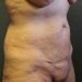 Tummy Tuck Patient 22 Before - 4 Thumbnail