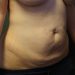 Tummy Tuck Patient 23 Before - 4 Thumbnail