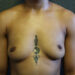 Breast Augmentation Patient 26 Before Thumbnail
