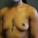 Breast Augmentation Patient 26 Before - 3 Thumbnail