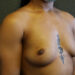 Breast Augmentation Patient 26 Before - 2 Thumbnail
