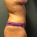Tummy Tuck Patient 25 After - 5 Thumbnail
