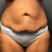 Tummy Tuck Patient 25 Before Thumbnail