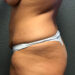 Tummy Tuck Patient 25 Before - 2 Thumbnail