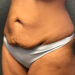 Tummy Tuck Patient 25 Before - 3 Thumbnail