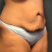 Tummy Tuck Patient 25 Before - 4 Thumbnail