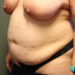 Tummy Tuck Patient 24 Before - 5 Thumbnail